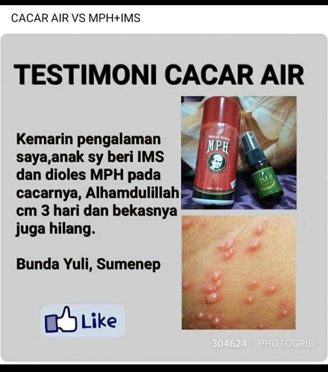 Testimoni Cacar Air dengan MPH dan IM-S