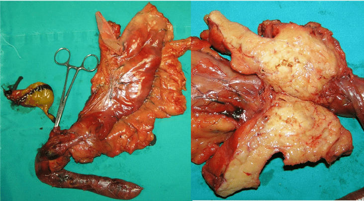 Resep Tumor