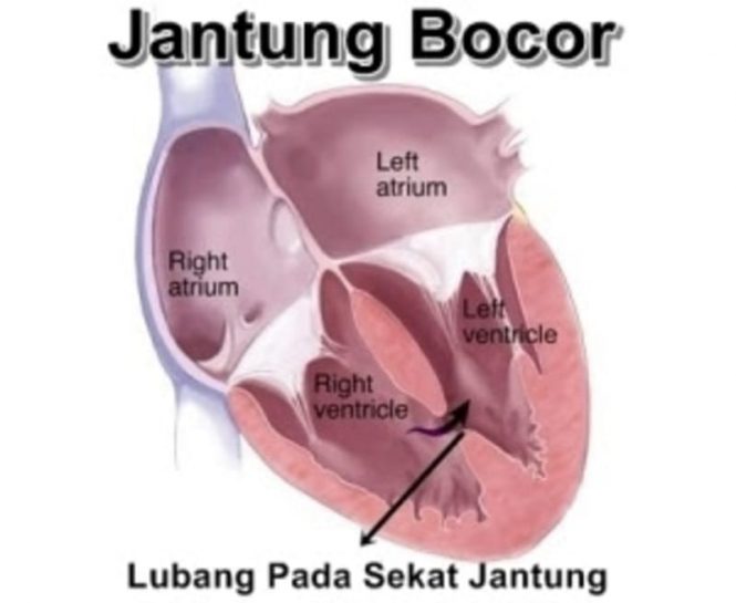 Testimoni Kesembuhan Jantung Bocor