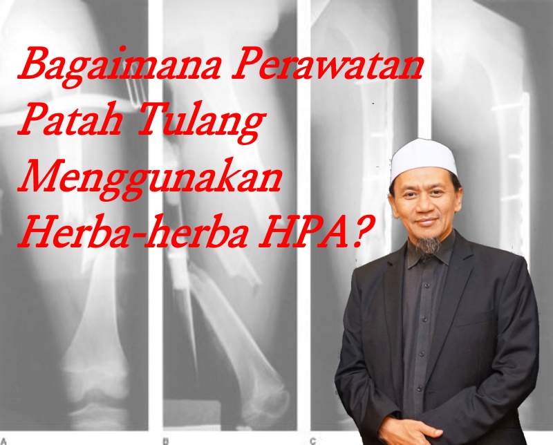 06. Bagaimana Perawatan Patah Tulang Menggunakan Herba-herba HPA?
